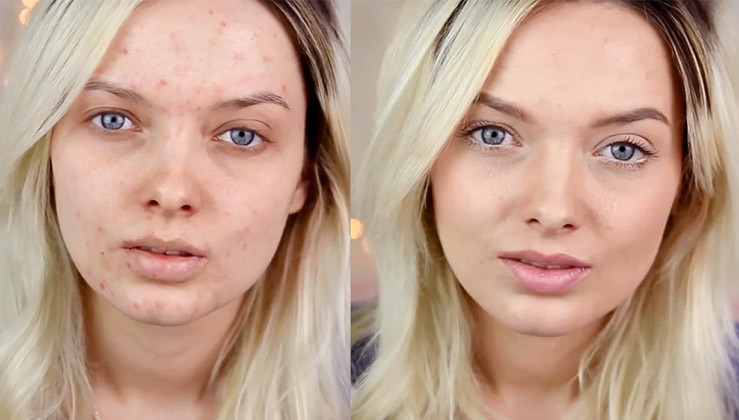 美芽美妆爆红痘痘女教你打造无暇肌